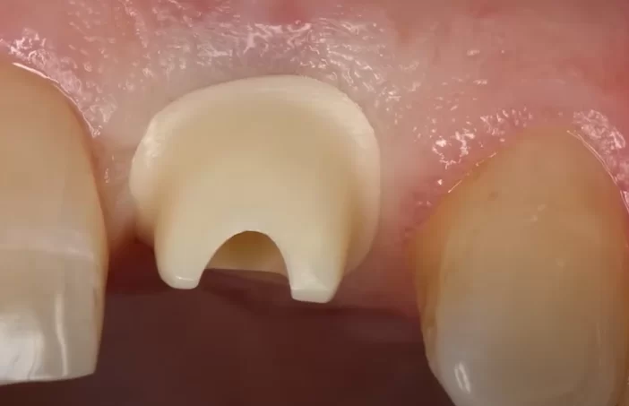 The border between the crown and abutment is above the gingival level - this allows the cement residue to be removed completely