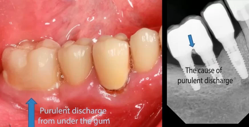 Purulent discharge around the paired restoration and cement residue on radiographs