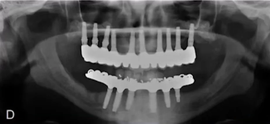 X-ray of a complete successful restoration of both dentitions