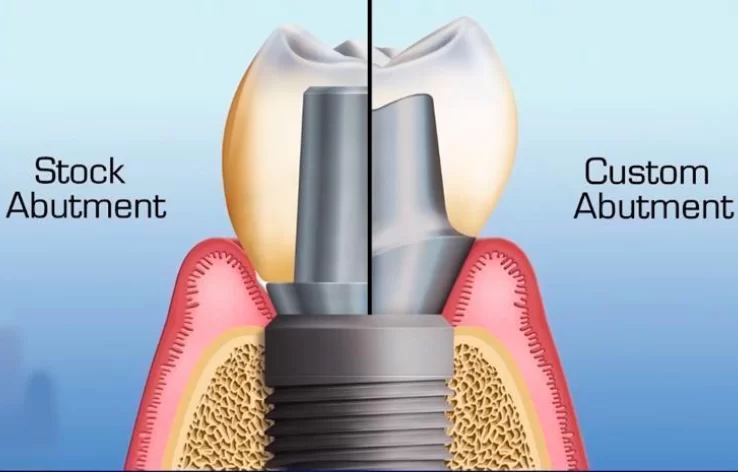 Comparison of standard and customized abutment in the gingival cuff section