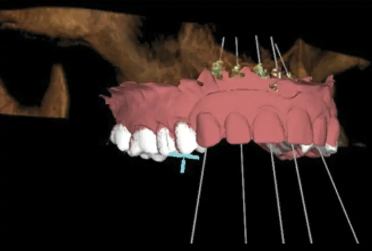 One of the stages of the digital treatment plan (screenshot of a temporary prosthesis)