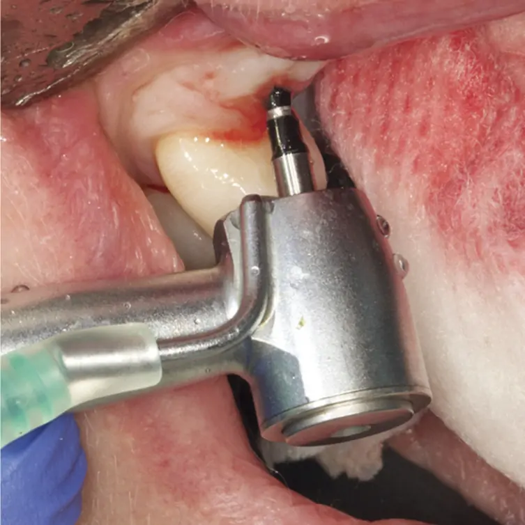 Implant placement using haptic robotic guidance. As osteotomies are prepared, the robotic arm locks the handpiece at the correct spatial position both in bodily direction and angulation, and as the clinician drills to proper depth, the arm prohibits further drilling apically