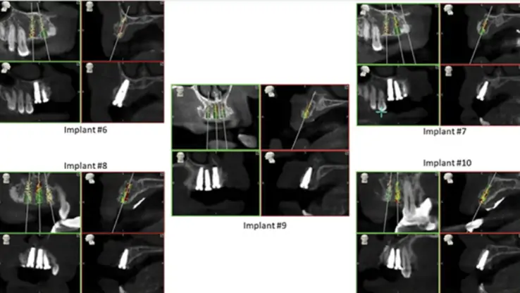 Postoperative cbct analysis showing accurate placement of the five anterior implants