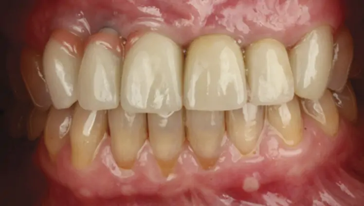 Final outcome at delivery of screw-retained milled ceramic crown restorations