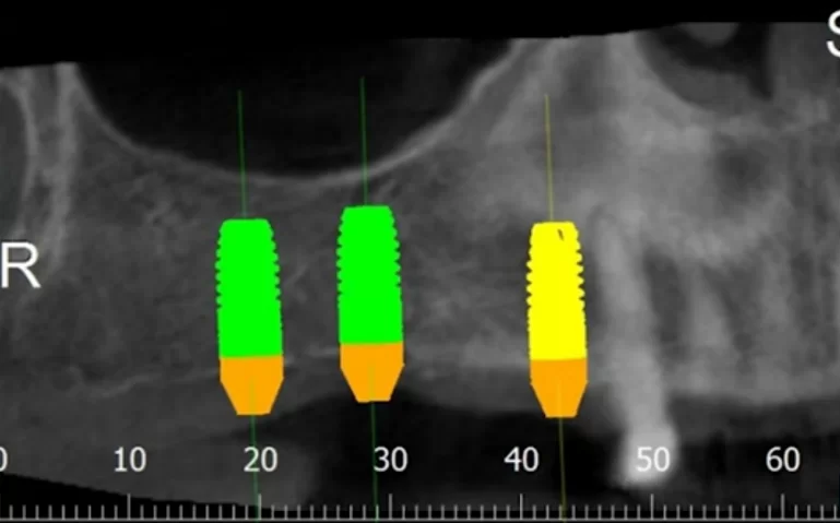 Planned placement of implants in the first quadrant