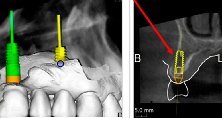 The visualization shows that fenestration of the implant in the area of the tooth 14 is possible