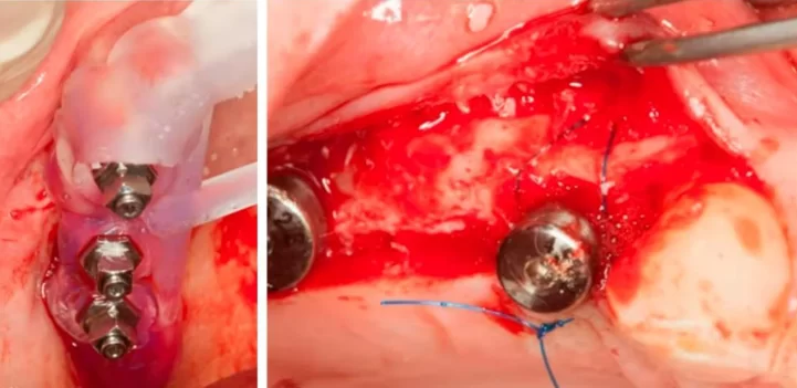 Implant placement sequence - surgical template (left), bone augmentation operation using the steigmann method, stage of fixation with a periosteal suture (right)