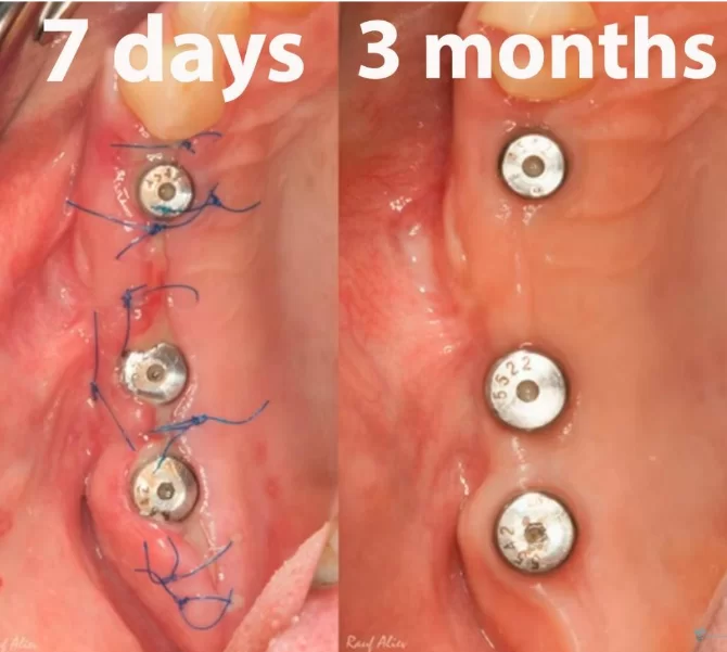 Condition of the soft tissues around the healing caps 7 days and 12 weeks after implant placement