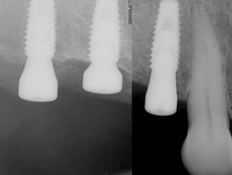 X-ray 3 months after implant placement