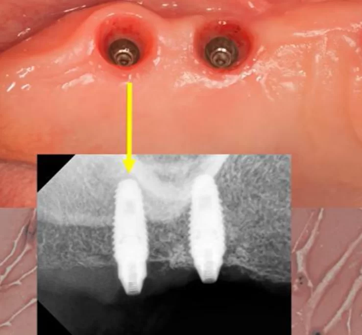 Photo of the implant in the area of tooth 17, which rotated when placing a multi-unit abutment