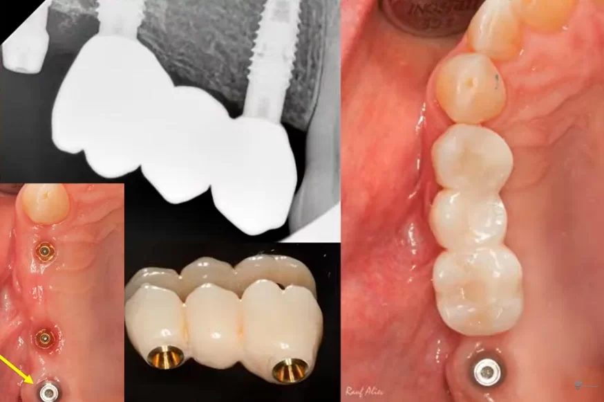 Placing a plug on a disintegrated implant and a bridge on the remaining two implants