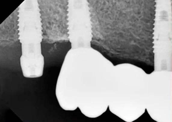 X-ray after 6 months of reosseointegration