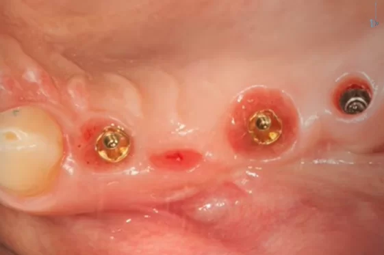 Condition of soft tissues after removal of the bridge and multi-unit abutment 6 months after the patient’s first visit