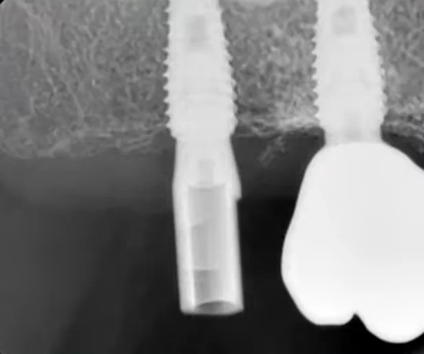 X-ray showing an implant with a scanning marker and part of an existing prosthesis