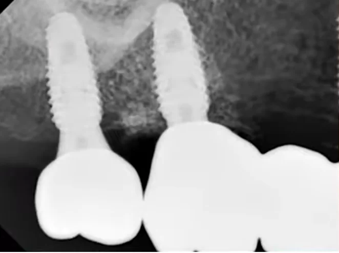 X-ray of a new single prosthesis