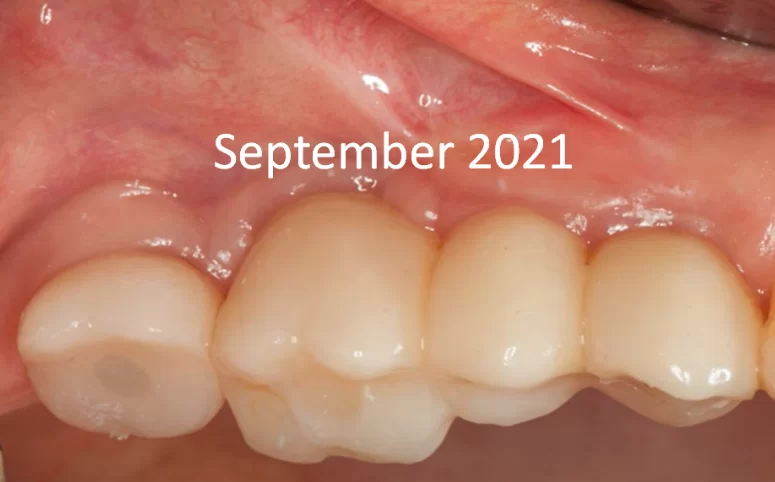 Screw-retained multi-unit restoration: single crown (left) bridge supported by two implants that restores three teeth (right)