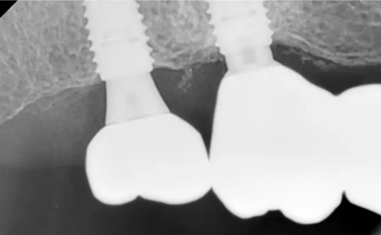 X-ray of the condition of the bone tissue in the area of the problematic implant (tooth 17)