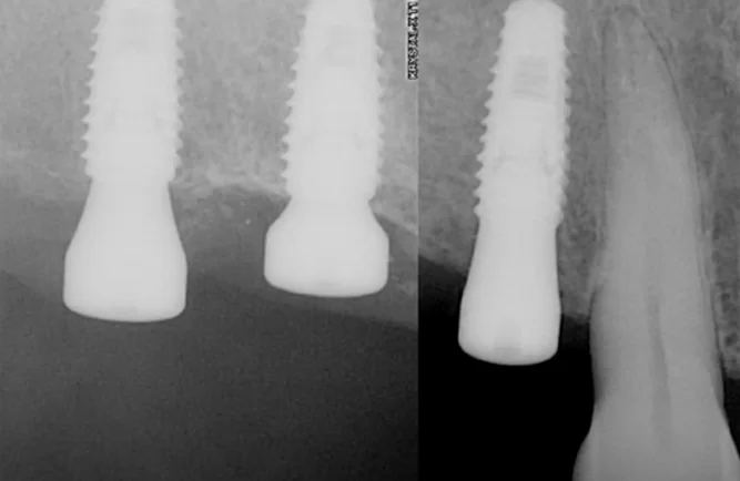 Initial radiograph taken before the implant was rotated