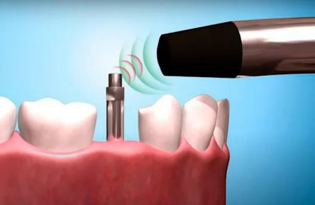 Resonance frequency analysis of implant stability