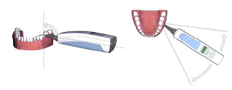 Checking implant stability with periotest