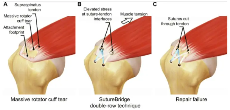 Unexpected results from a study of python teeth: a new approach in shoulder rotator cuff repair in humans unexpected results from a study of python teeth a new approach in shoulder rotator cuff repair in humans 2