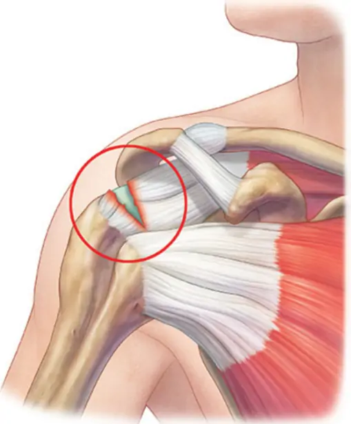 Rotator cuff tear of the shoulder