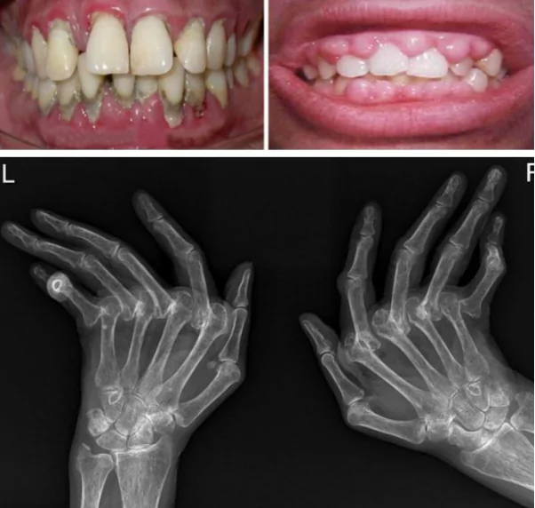 The Connection Between Periodontal Disease and Rheumatoid Arthritis: Insights from Recent Research