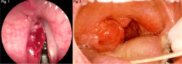 Head and neck squamous cell carcinoma (hnscc)