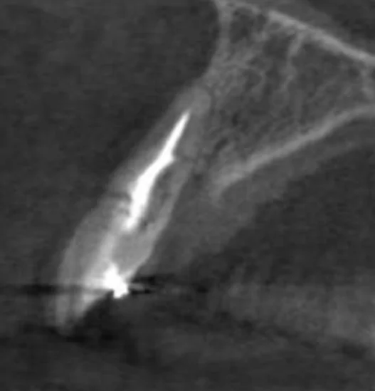 Cross-sectional view of the same tooth, demonstrating severe internal root resorption.