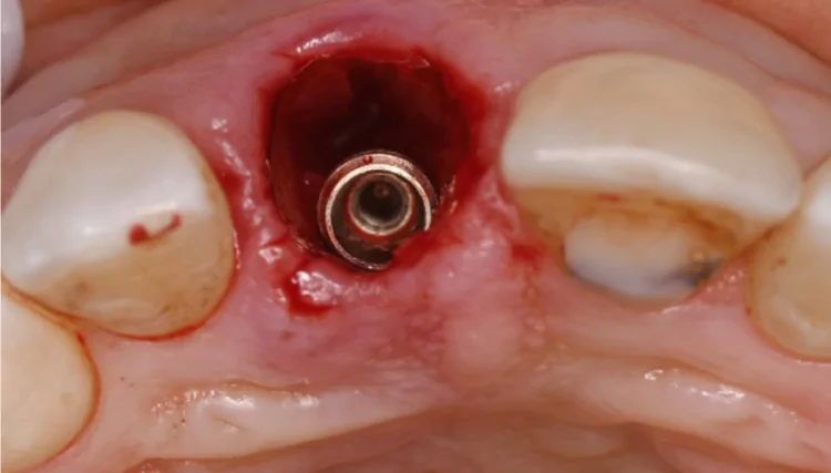 Immediate (right after extraction) implant placement - the implant is shifted to the palatal aspect of the extraction socket.