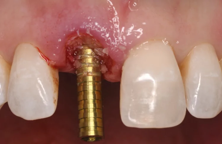 A New Method for Soft Tissue Restoration in the Aesthetic Zone: Dermal Apron Technique with a Clinical Case Example