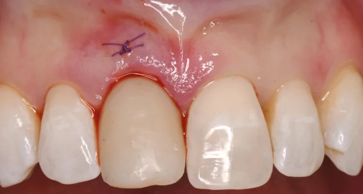 Screw-retained provisional crown, out of occlusal contact is delivered and the dermal allograft successfully inserted, the upper edge of the dermal implant fixed with a suture.