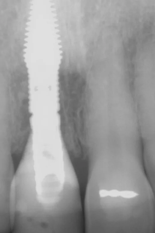 Post-operative radiograph confirming complete seating of the provisional restoration and the dual-zone bone graft is visible mesially and distally.