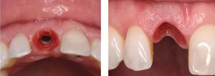 Healthy thick mucosa - the original scallop of the gingiva is preserved via immediate provisionalization.