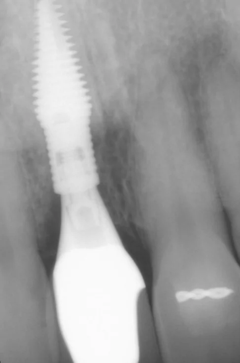 Radiograph at time of crown-delivery. The narrow coronal portion of the implant increases space between the implant and adjacent teeth.