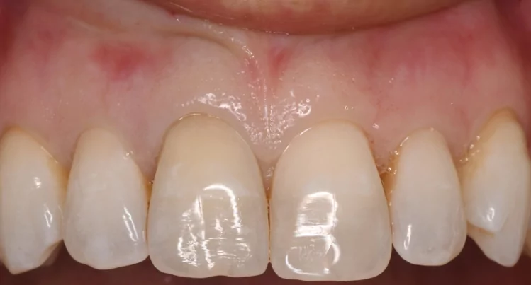 External appearance of the maxillary right central incisor with internal root resorption.