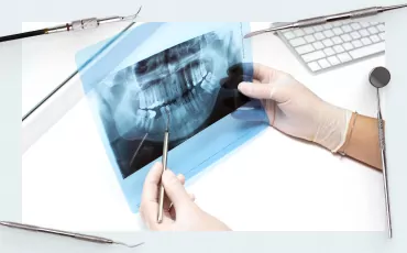 Comparison Between Digital and Conventional Workflow in Implant Prosthetic Rehabilitation: A Randomized Controlled Trial