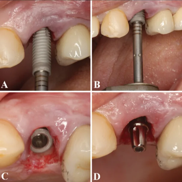 (a) after tooth removal, a dental implant (3. 5 × 13 mm) was placed into the fresh extraction socket. The drilling sequence started with a spear drill, followed by a 2 mm cylindrical drill, and a 3. 5 mm conical-shaped drill concerning the mesial, distal, and palatal spaces to accomplish adequate tridimensional positioning. (b) the implant placement was performed with a flapless technique preserving the interdental papillae. (c) implant alignment was slightly palatal, at least 2 mm distant from the nearby teeth in the mesial and distal region, and the primary implant stability achieved was 42 ncm. (d) a titanium cylinder was attached to the implant platform. /wiley/online library/gabriel mulinari-santos