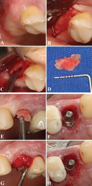 (a) the maxillary tuberosity was the region utilized to obtain the autogenous bone block graft. (b) after local infiltrative anesthesia, a vertical and crestal incision was performed following a full-thickness flap to access the right maxillary tuberosity. (c) a straight chisel (quinelato, rio claro, sp, brazil) was used to harvest the block bone. (d) the bone graft was customized according to the form of the bone defect, (e) and it was then inserted gently into the alveolar defect above the implant threads using the flapless technique. (f) occlusal view of the fresh extraction socket with the dental implant positioned immediately after the buccal wall reconstruction with the tuberosity bone graft, allowing a reminiscent gap between the block bone and the implant. (g) the gap was filled with particulate bone harvested from the tuberosity and ground with a bone mill (neodent, curitiba, pr, brazil) to guarantee the bone block maintenance and support. (h) final occlusal view of the particulate bone completely inserted into the gap between the block bone and the implant. /wiley/online library/gabriel mulinari-santos