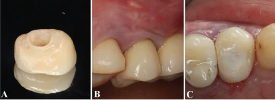 (a) after the surgical procedures, the provisional resin crown was customized. (b) prosthesis adjustments were performed to guarantee a proper emergence profile. (c) the tooth incisal height was reduced to avoid occlusal contact during chewing and phonation. /wiley/online library/gabriel mulinari-santos