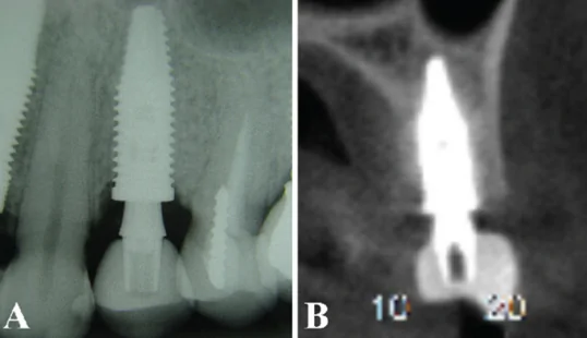 (a) the periapical radiography showed a complete implant osseointegration without signs of bone resorption. (b) the computed tomography scan showed no bone alterations in width and height surrounding the implant.