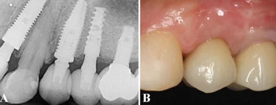 (a) periapical radiographs after 9 years of follow-up showed the implant position and the vertical bone gain without marginal bone resorption. (b) the clinical examination revealed an adequate gingival thickness, without gingival recession or probing depths, confirming the satisfying esthetic result by the idr treatment. /wiley/online library/gabriel mulinari-santos