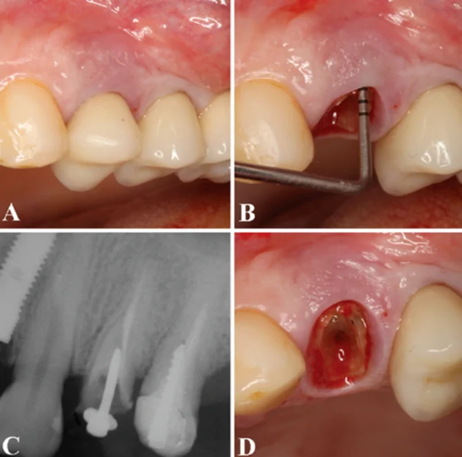 (a) the clinical examination showed class i tooth mobility, unsatisfactory endodontic treatment, and a ceramic crown. (b) the periodontal probing confirmed 10 mm of probing depth in the buccal side. (c) periapical radiograph revealed an inadequate endodontic treatment and vertical bone loss on the mesial and distal of the tooth, and the bone height above the root apex was 8 mm. (d) after prosthesis removal, a vertical fracture in the mesial side of the teeth was observed, which indicated its extraction. /wiley/online library/gabriel mulinari-santos