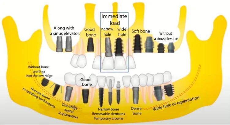 Approximate schematic of how implants of different shapes might be used in various clinical situations youtube / dr. Kamil khabiev / dental guru academy