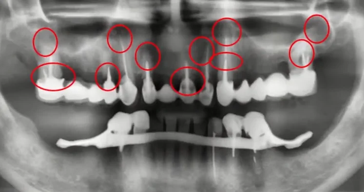 The patient's complaints are regarding the four mobile and painful front teeth of the upper jaw. Problem areas are marked in red, including those not yet causing symptoms youtube / dr. Kamil khabiev / dental guru academy